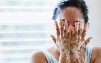 Vitiligo : Could You or Someone You Know Be Affected?
