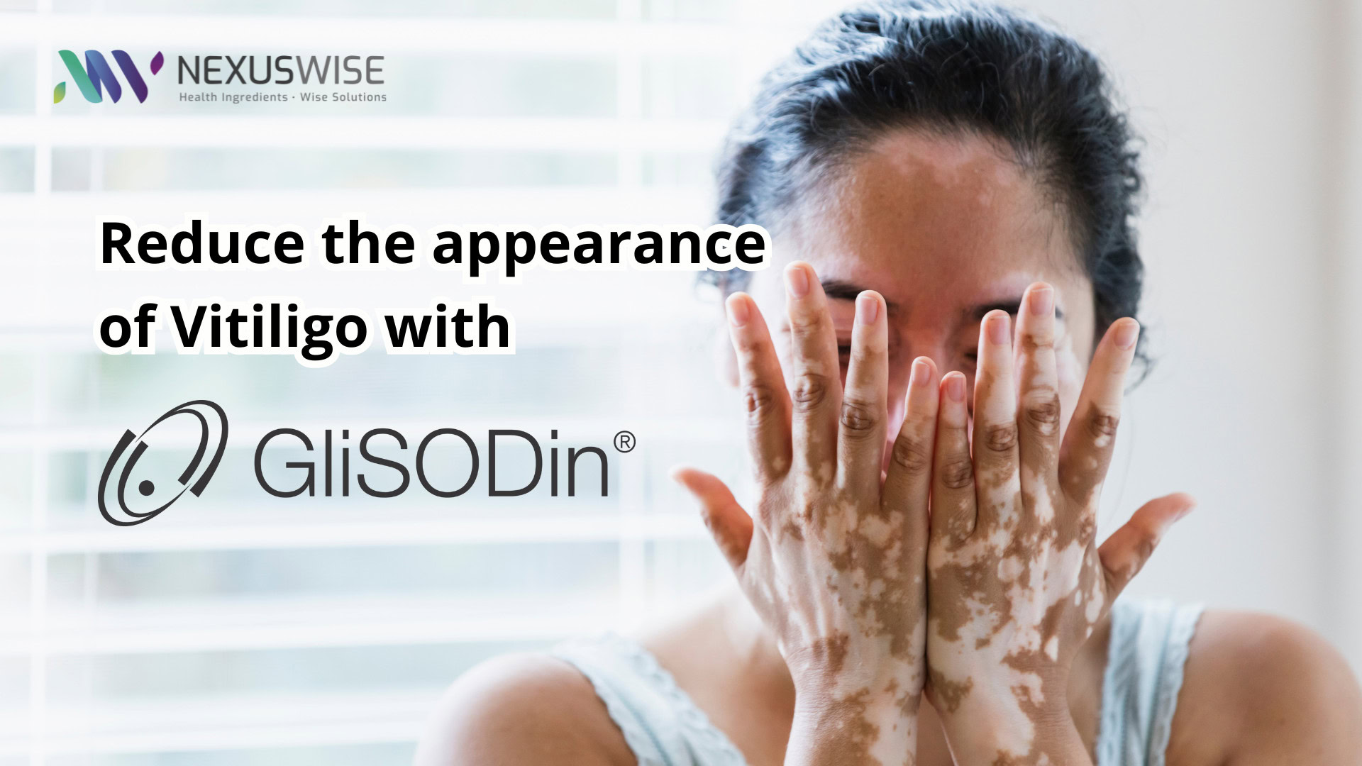nw vitiligo could you or someone you know be affected 03